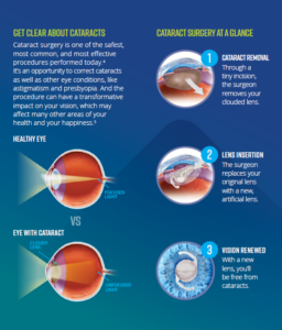 Facts About Cataract Surgery Oklahoma Eye Surgeons